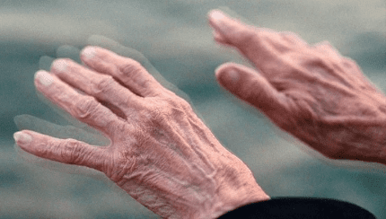 SUS terá medicamento para tratamento de Parkinsonne demência